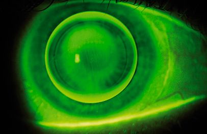 Novóptica Ojo con lentes de contacto semirrígido